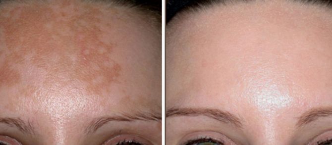 Before &After
